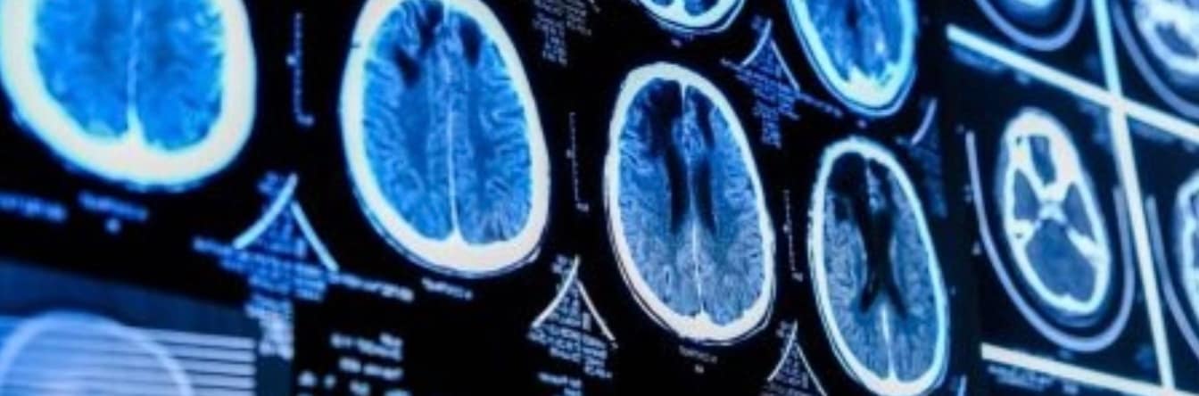 Medical images of brains
