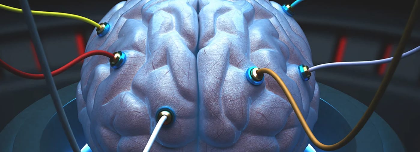 Image of brain with electrodes attached