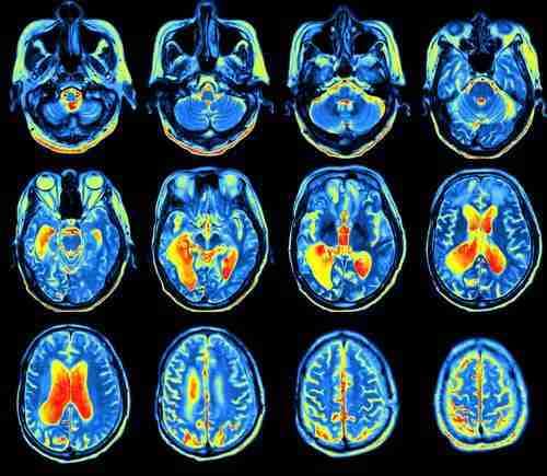Brain scans