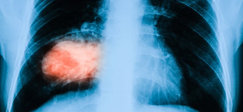 medical image of lungs