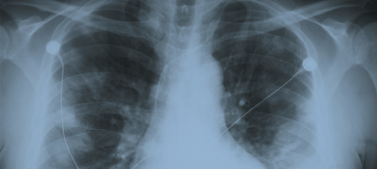 Chest Xray of injection drug user