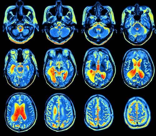 Brain scans